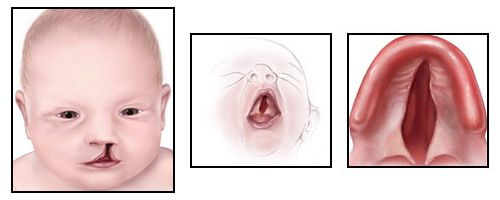 Examples of baby with cleft lip and palate.