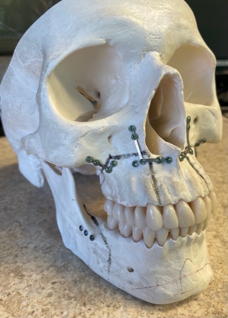 Skull with plates and screws used during orthognathic surgery