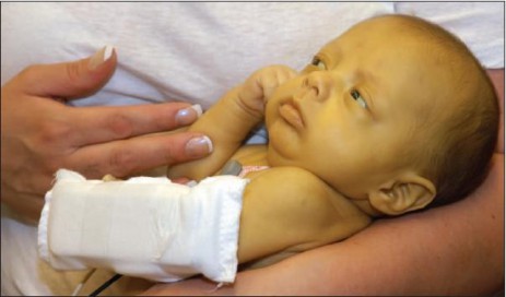 Baby with a cast on its arm lying in someone's arms
