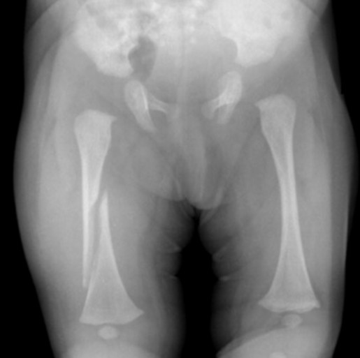 x-ray of a femur fracture