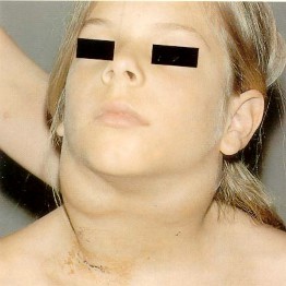 Young girl with swollen neck