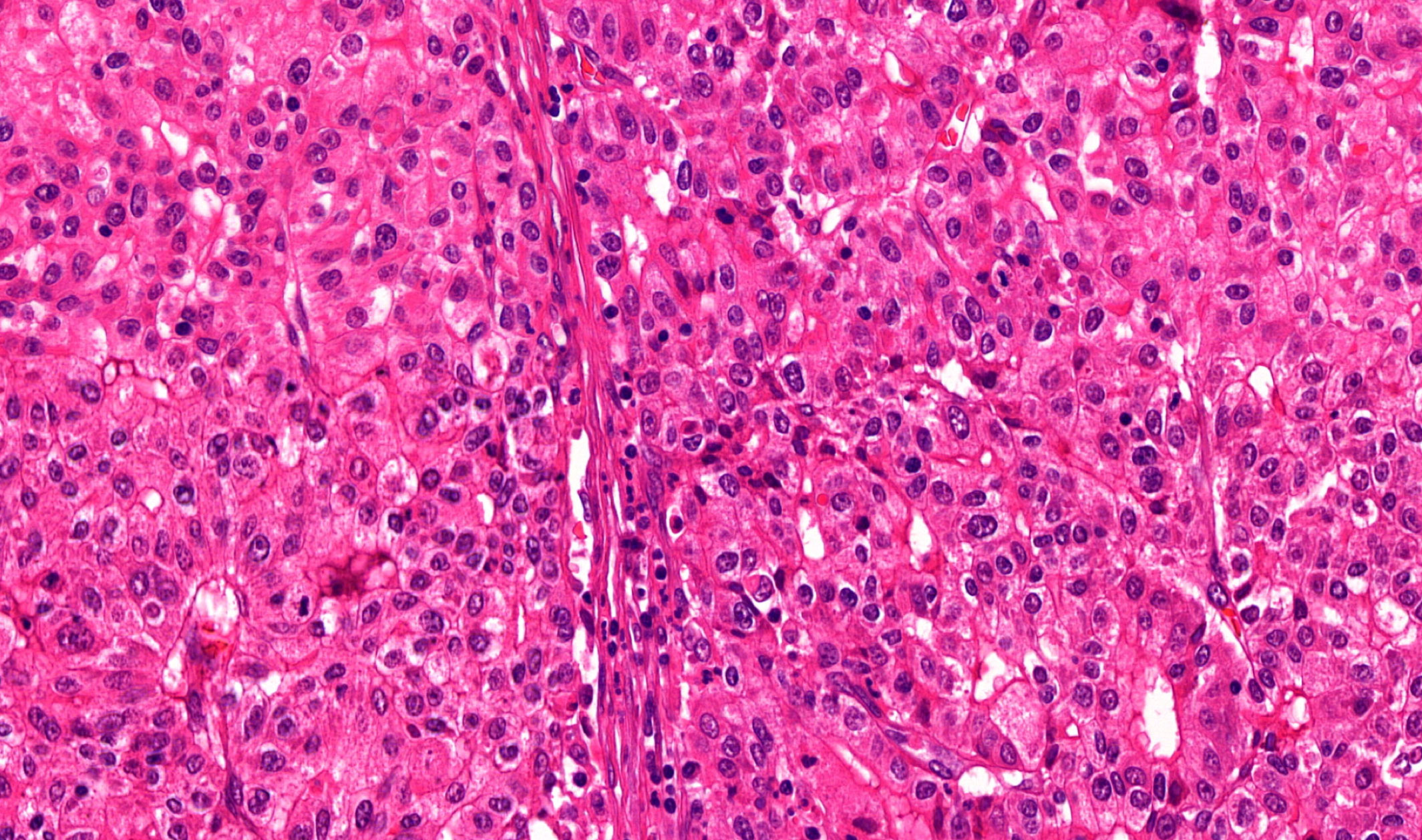 Fibrolamellar Carcinoma Cell